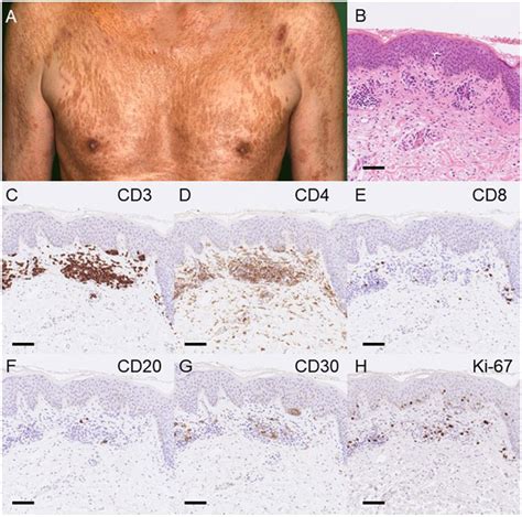 Frontiers Publishing Partnerships Rechallenge Of Brentuximab Vedotin Was Effective For