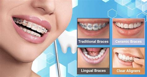 Orthodontic Appliances Types And Their Roles In Straightening Teeth