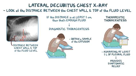 Pleural Effusion Signs And Symptoms