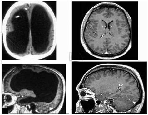 Man With Tiny Brain Shocks Doctors New Scientist