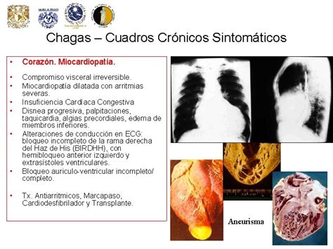 Enfermedad De Chagas Cuadros Clnicos Y Tratamiento Dra