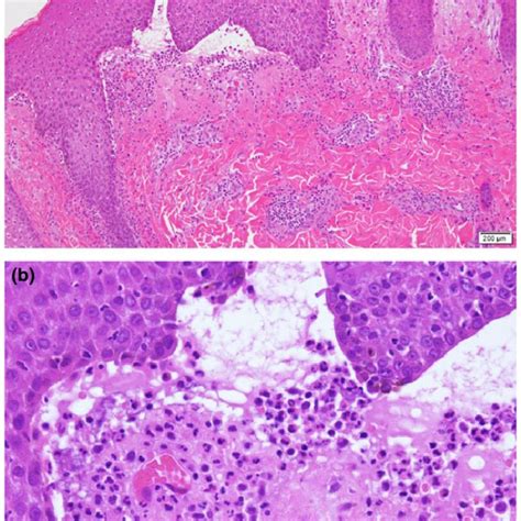 Ab Histopathology Of A Skin Biopsy Specimen Taken From An