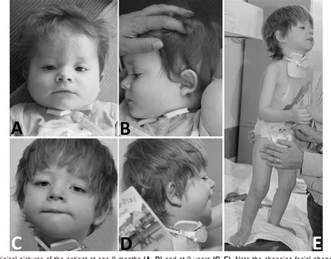 Figure From A Severe Congenital Myasthenic Syndrome With Dropped