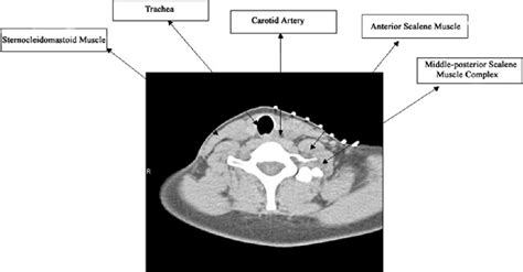 Figure 1 From Single Ct Guided Chemodenervation Of The Anterior Scalene