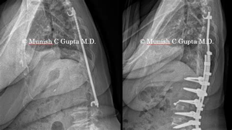 Revision Adult Idiopathic Scoliosis Female Munish C Gupta Md