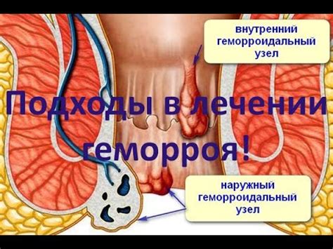 Геморрой - причины, симптомы и лечение - YouTube