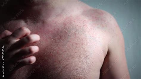 Vidéo Stock Serious Rashes Of The Skin Of Human Chest Small Red Itchy Pimples On Skin Surface