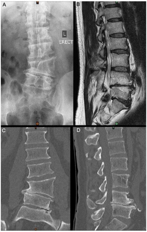 Surgical Techniques Development Free Full Text Anterior Lumbar