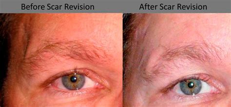 Scar Revision Before And After 10 Weber Facial Plastic Surgery