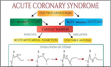 Acute Coronary Syndrome: Causes, Risk Factors, Symptoms, Treatment