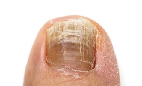 Causes And Treatments Of Yellow Toenails