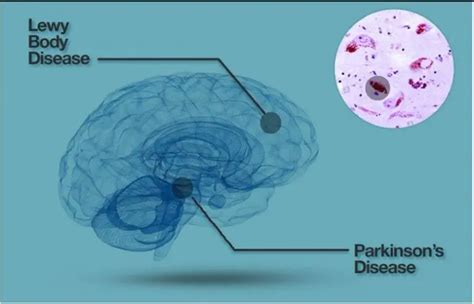 Qué son los cuerpos de Lewy Pinceladas para que entiendas el