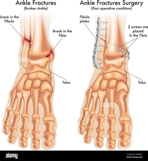 medical illustration compares a fractured ankle before and after ...