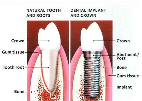 Single Tooth Dental Implant Dr Salim Kapadia Dental Centre