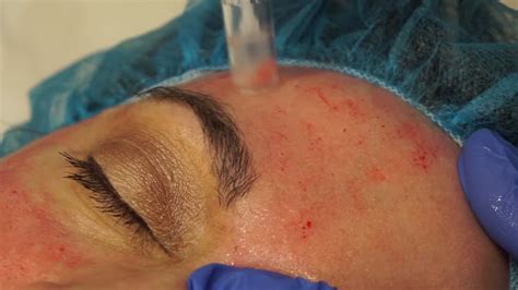 Microneedling Austin Plastic Surgery Institute Skin Care Clinic