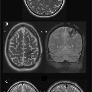 Preoperative Magnetic Resonance Image Mri T Sequence A Patient