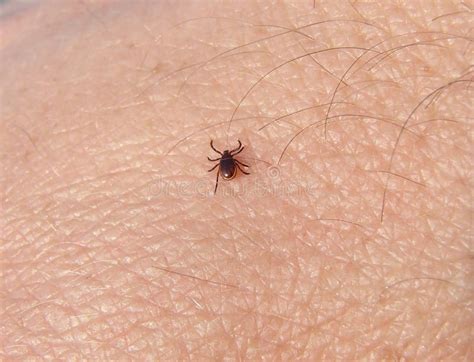 Persulcatus De Tick Ixodes Que Camina En El Primer Humano De La Piel