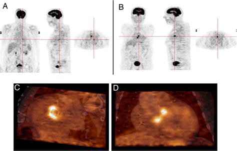 Infective Endocarditis In The Native Mitral Valve And Bioprosthetic Download Scientific Diagram