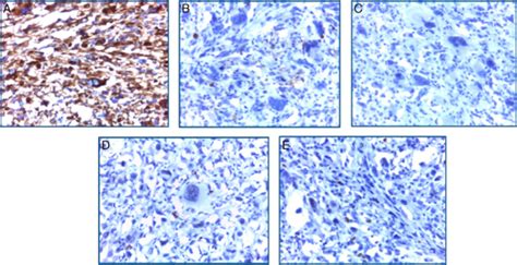 Microscopia 40x inmunohistoquímica A Vimentina positivo intenso