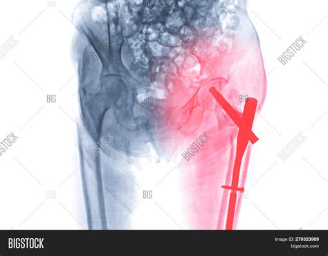 X-ray Left Hip Image & Photo (Free Trial) | Bigstock