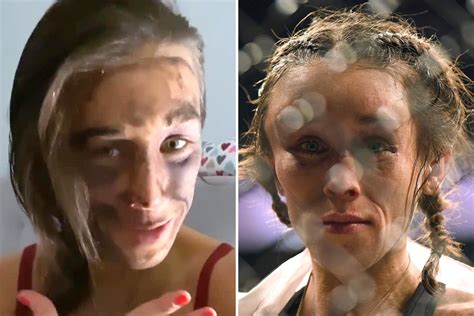 Joanna Jedrzejczyk Shows Off Shockingly Discoloured Face After Terrifying Haemotoma In Ufc 248