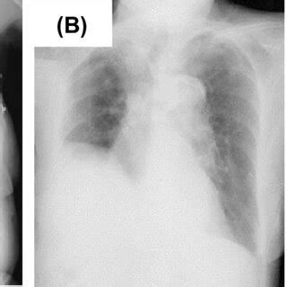 Chest Radiographs Of Patient 1 A Chest Radiograph On Admission Showing