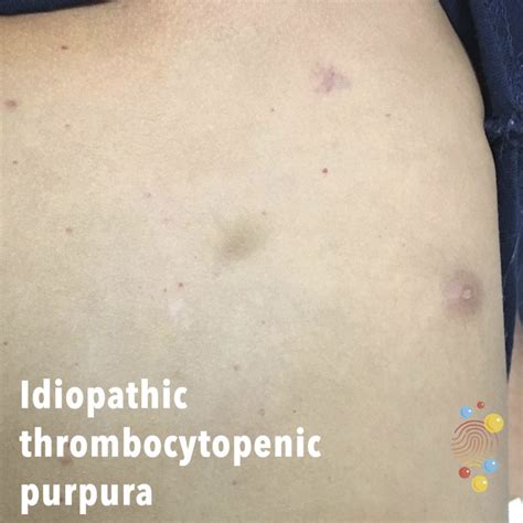 Idiopathic Thrombocytopenic Purpura Rash