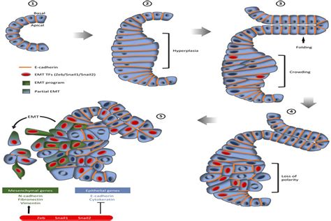 The Steps Of Pancreatic Cancer Progression From A Normal Pancreatic