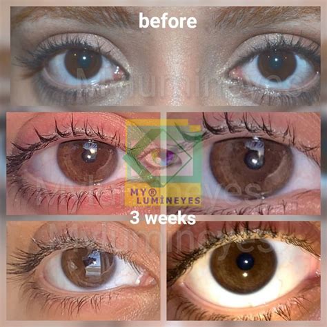 Before And After Photos Of Laser Eye Color Change Surgery