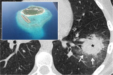 Chest Imaging Using Signs Symbols And Naturalistic Images A