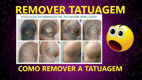 Remover A Tatuagem Como Remover A Tatuagem Remover Tatoo Remover