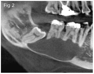 Keratocystic Odontogenic Tumor KCOT Of The Mandible Dental News