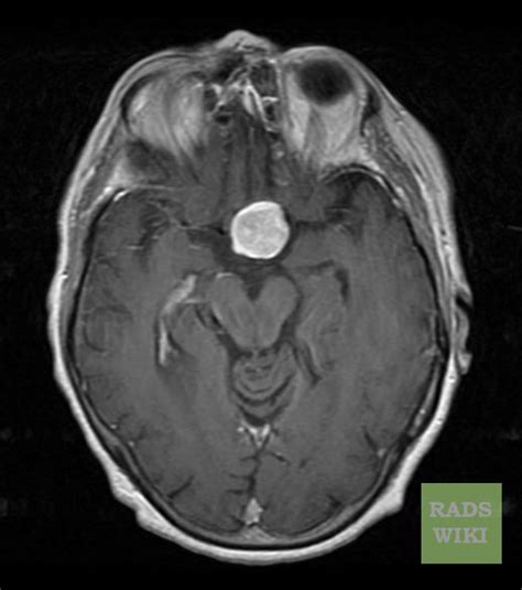 Pituitary adenoma MRI - wikidoc