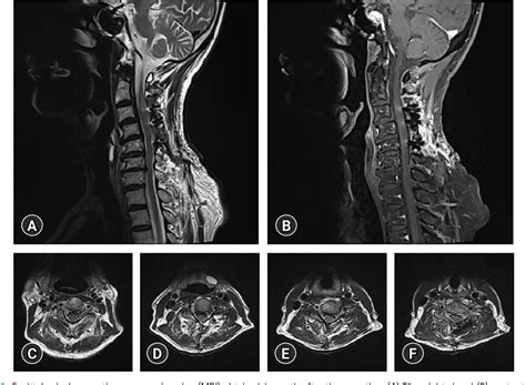 Figure From Idiopathic Hypertrophic Spinal Pachymeningitis With