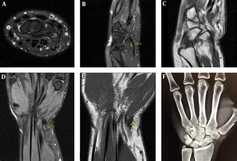 Acute Calcific Tendinitis Of Flexor Carpi Ulnaris A Big Mimicker And