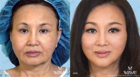 Endoscopic Facelift In Los Angeles Natural Results