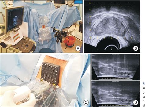 Figure 1 From The Clinical Utility Of Transperineal Template Guided