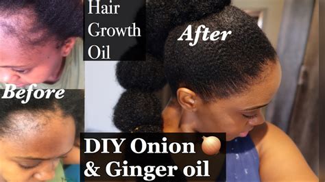 Onion Oil To Grow Bald Edges Grow Your Edges Back Fast Natural Hair