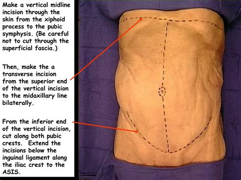 Ppt Dissection Of The Anterior Abdominal Wall Powerpoint Presentation