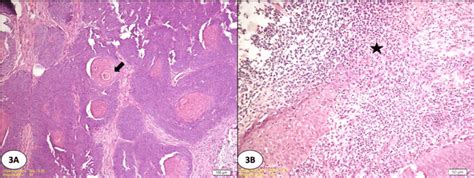 A High Grade Epithelial Hyperplasia From The Mucosa To The Submucosa