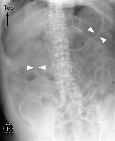 Riglers Sign In A Patient With Massive Pneumoperitoneum Emergency