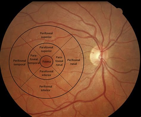 Retinal Drusen Are More Common And Larger In Systemic Lupus