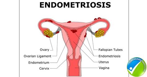 Endometrial Hyperplasia Causes Symptom Diagnosis And More