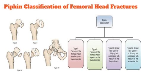 Emergency Management Of Hip Dislocations Pelvic Fractures Pdf