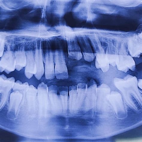 Panoramic view radiography of patient | Download Scientific Diagram