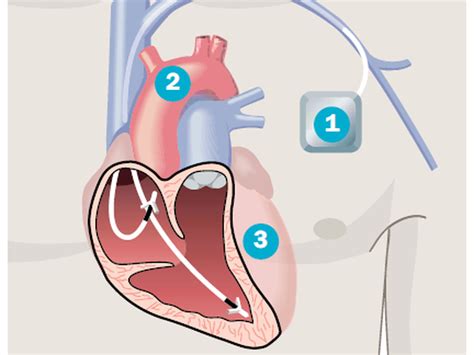 Wann Ist Ein Herzschrittmacher Notwendig Und Wie Lebt Man Damit
