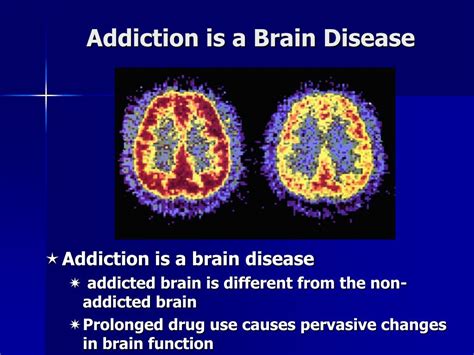 Ppt Addiction Is A Brain Disease Powerpoint Presentation Free