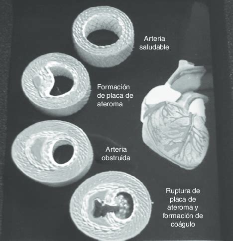 Representación esquemática del ateroma hasta que se presenta la rotura ...