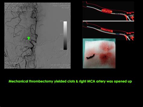 The Hong Kong Minimally Invasive Brain And Spine Neurosurgery Centre Emergency Stroke Care