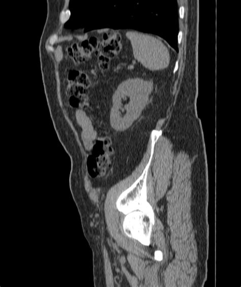 Radiopaedia Case Urinary Bladder Hernia Id Study Nc Commons